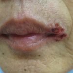 張嘴就裂…唇皰疹比生理期惱人