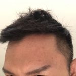 對抗青春痘 4禁忌別犯