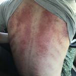 刮痧愈紅愈有效?中醫師:反而傷了身體