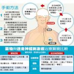 台灣醫療奇蹟/刺激迷走神經 「控電」治癲癇