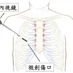 心臟手術改「微創」 縮短病患恢復期